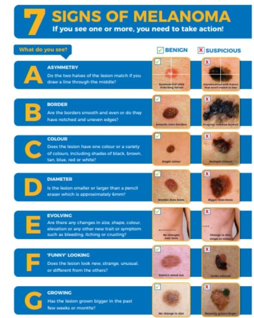 Is Your Birthmark Hiding A Melanoma is-your-birthmark-hiding-a-melanoma